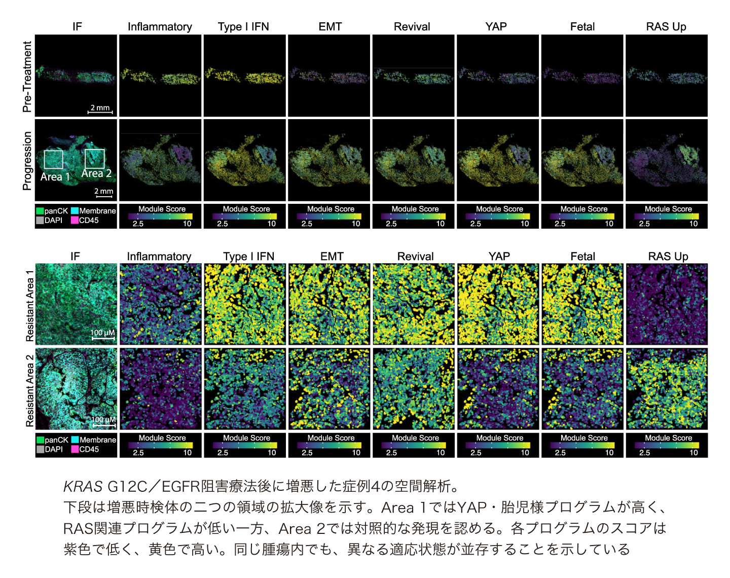 標的治療が効く間、腫瘍は何をしているのか | ドクターズアイ 岩井拓磨