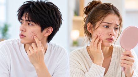 尋常性痤瘡、罹患率・有病率が30年で6割超上昇