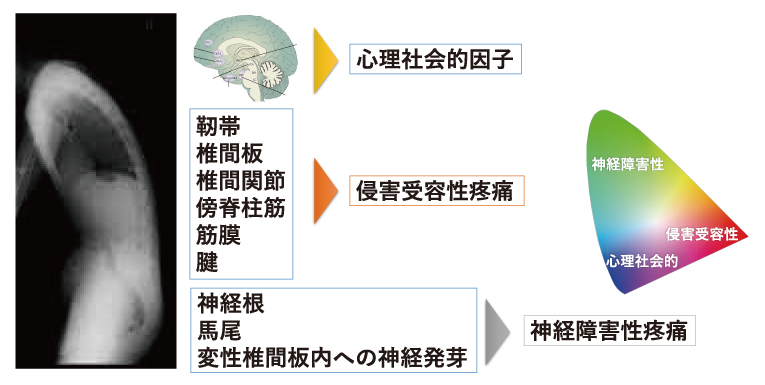 国民病の慢性腰痛に新タイプの貼付薬が登場 | 医学ニュース | Medical Tribune