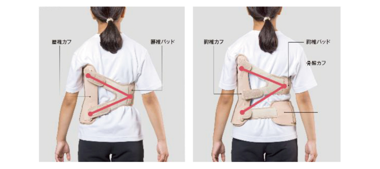 思春期の側弯症、装具療法に新たな選択肢 | 医学ニュース | Medical