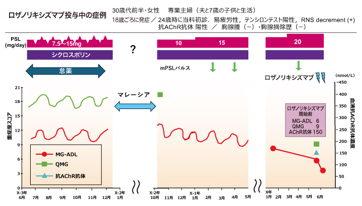 ロザノリキシズマブ、重症筋無力症の至適症例は？ | 医学ニュース