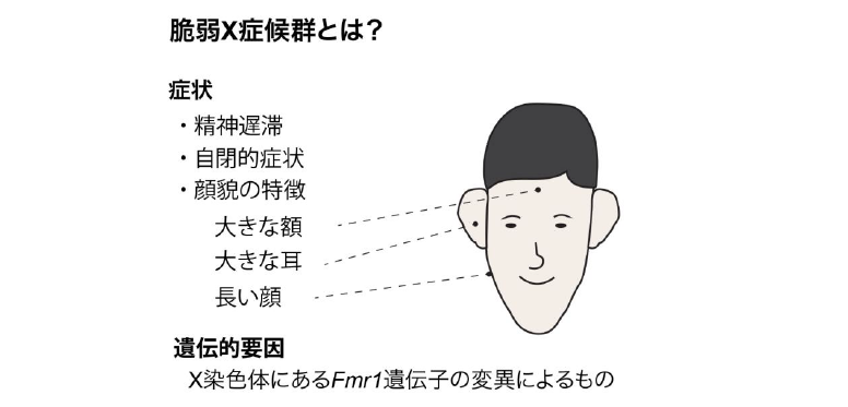 fragile X syndrome1.png