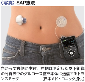 3＞SAP療法は究極のインスリン治療になるか | 糖尿病薬物療法 