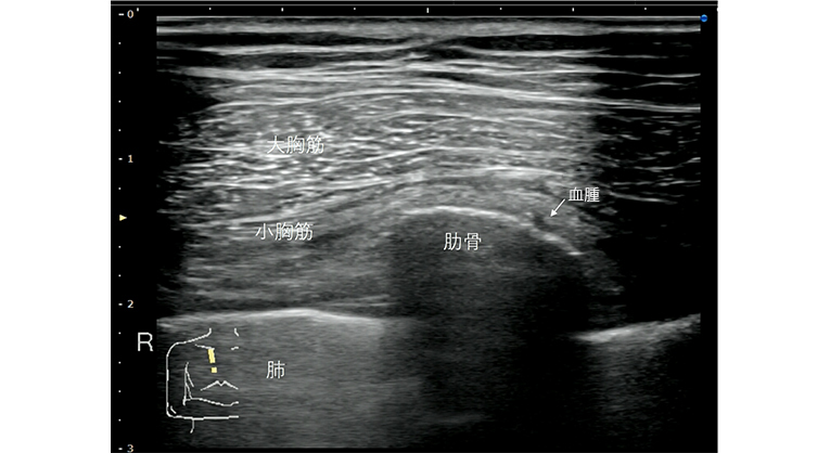 肋骨骨折、エコーで診断したことがある人、手を上げて！ | 1から始める