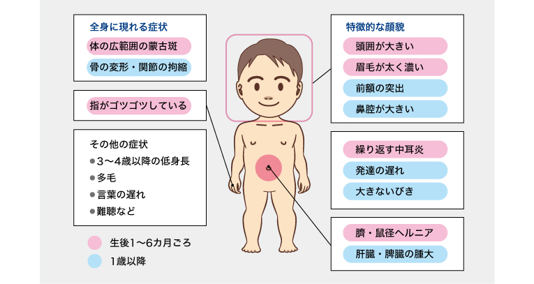 ムコ多糖症UPDATE ムコ多糖症Ⅱ型について｜教えて！ムコタ先生〜ムコ多糖症相談室〜