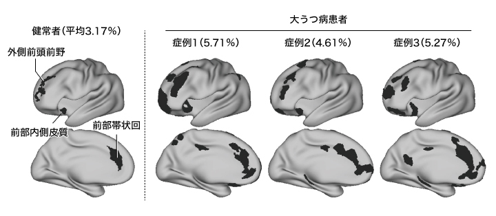 精神科医の夢「うつ病を検査する」はかなうか | ドクターズアイ 加藤